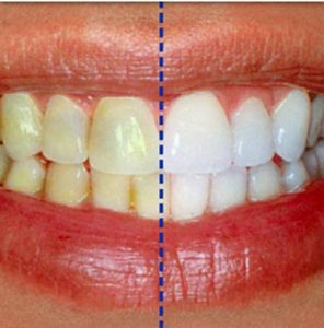 Read more about the article The Revolution of Aesthetic Orthodontics